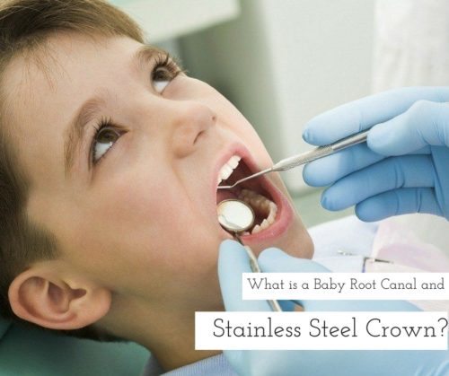 What is a "Baby Root Canal and Stainless Steel Crown?