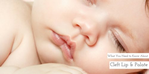 What You Need to Know About Cleft Lip and Palate
